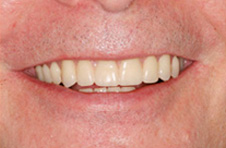 Smile Gallery - After