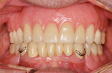 Smile Gallery - After