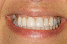 Smile Gallery - After