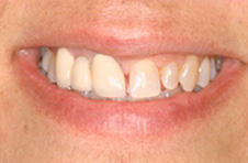 Smile Gallery - Before