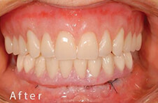 Smile Gallery - After