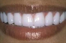 Smile Gallery - After